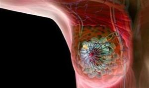 乳腺癌基本不疼不癢 乳腺結節(jié)會變成癌癥嗎？乳腺DR行業(yè)市場競爭及發(fā)展前景